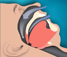 Airway Blog