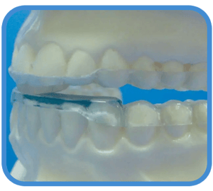 B Splint