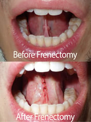 Before and After Frenectomy