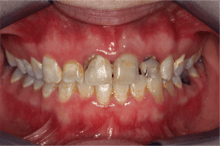 Carious lesions and an abscessed tooth