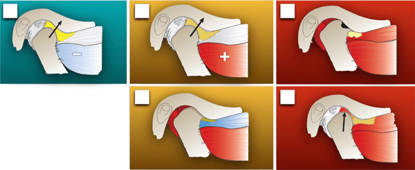 Educating Patients- The TMJ joint (4 different phases of the joint)