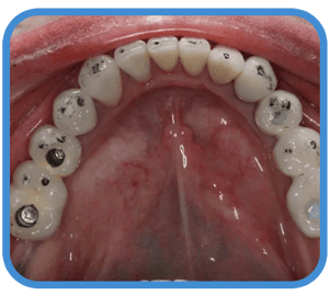 Functional Occlusion